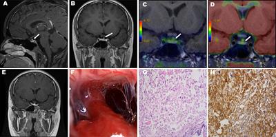 Case Report and Literature Review: Ectopic Thyrotropin-Secreting Pituitary Adenoma in the Suprasellar Region